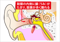 急性中耳炎の図解