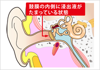 滲出性中耳炎の図解
