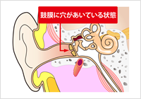 慢性中耳炎の図解 鼓膜の内側に膿（うみ）がたまり、鼓膜が赤く腫れる